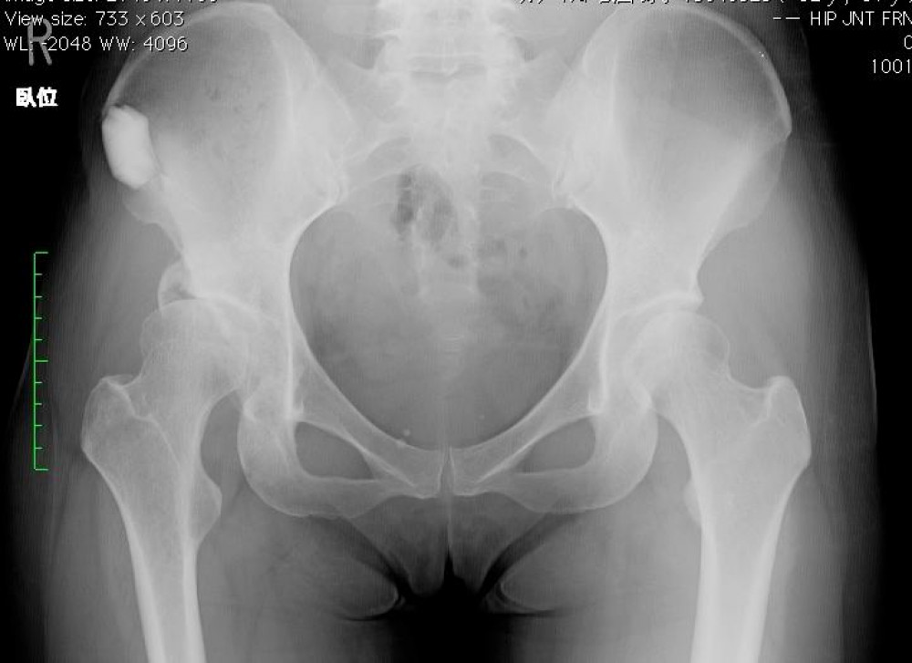 股関節痛の先進の 保存施術 Ginzaplus ギンザプラス