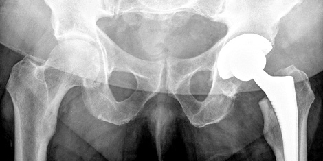 なぜ 手術療法 ではなく 保存療法 なのか 股関節痛の 保存施術 Ginzaplus ギンザプラス