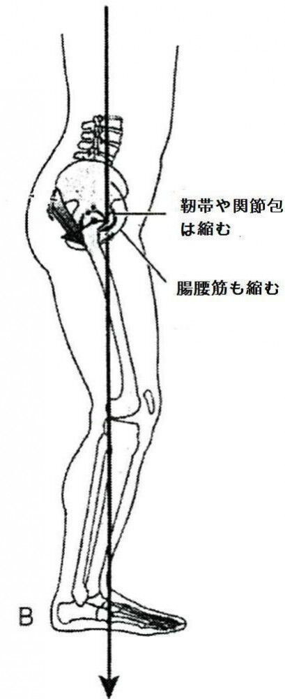痛みを避ける姿勢が更なるトラブルを招く