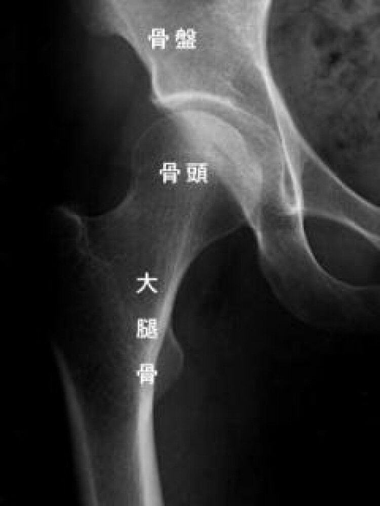大腿骨と骨盤の兄弟関係