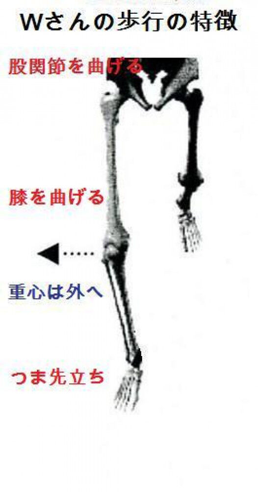 歩行分析