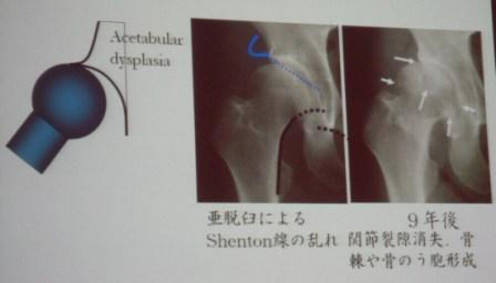 臼蓋形成不全 進行の仕方