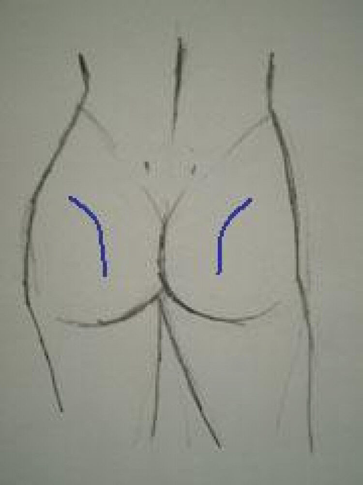 [保存施術] お尻のえくぼ
