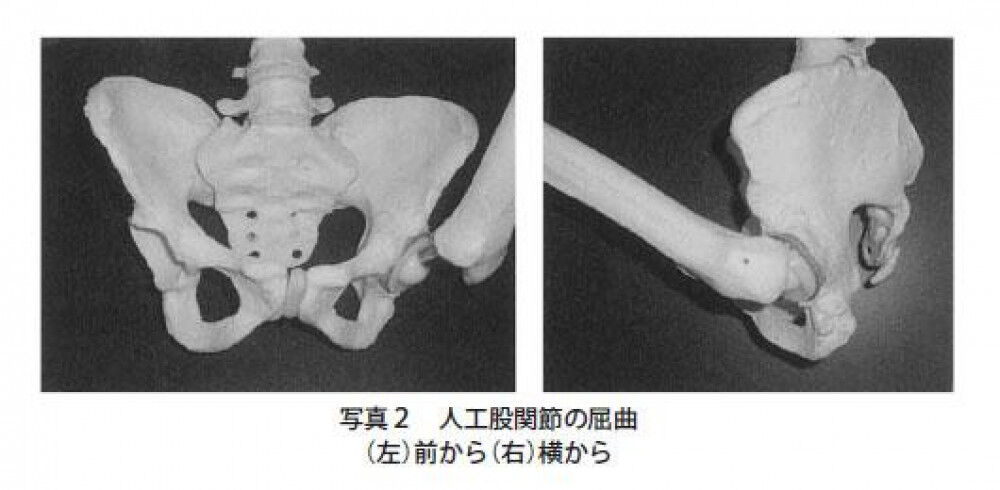 [研究論文] 先天的臼蓋形成不全と後天的臼蓋形成不全