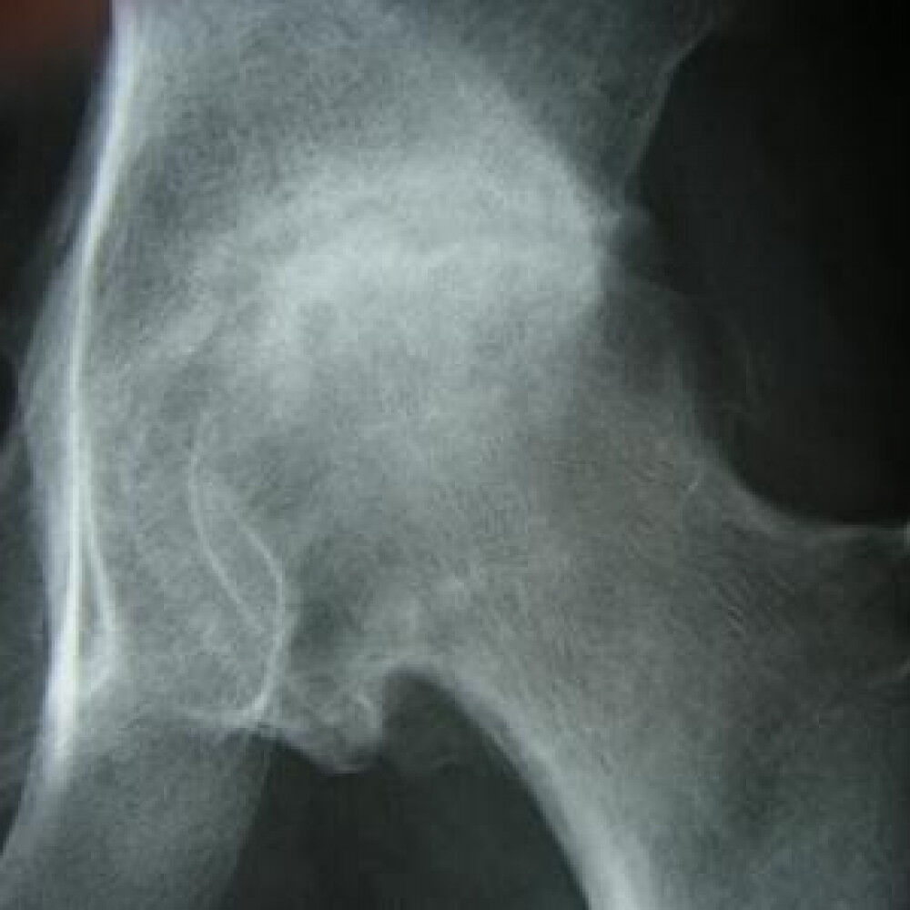 [研究論文] 臼蓋形成不全への保存療法の効果