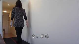 [施術事例] 30代 RAO後20年 変形性股関節症 進行期