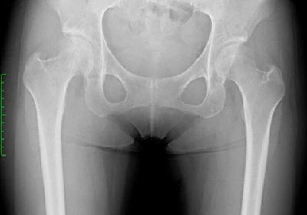 [施術事例] 30代 大腿骨頸部骨折 転倒