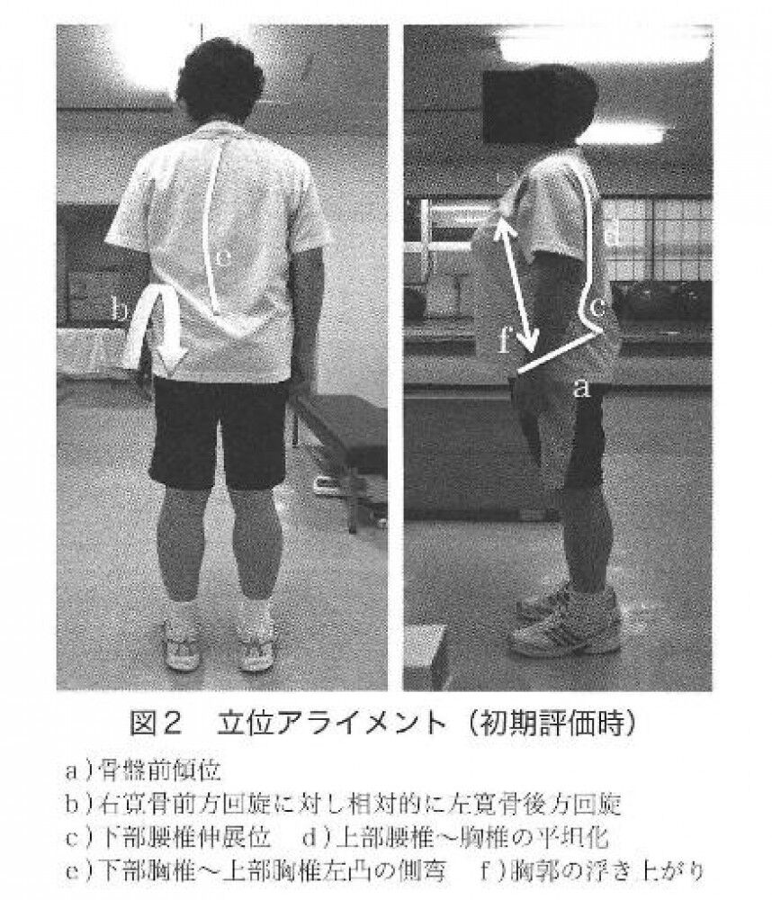 [研究報告] 術後の姿勢の特徴