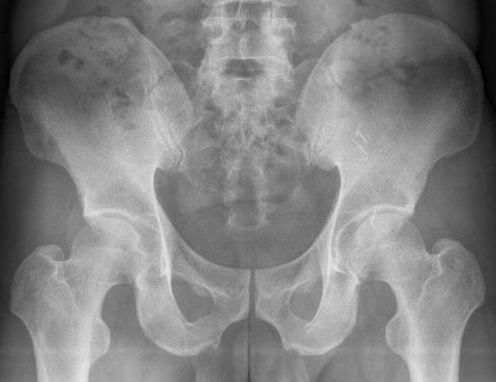 [施術事例] 50代 鼠径部痛症候群 グロインペイン
