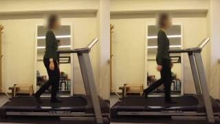 [施術事例] 30代 臼蓋形成不全 ヨガ