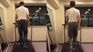 [施術事例] 50代 股関節唇損傷 医師