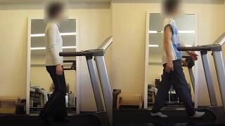 [施術事例] 50代 臼蓋形成不全 人工関節を勧められて