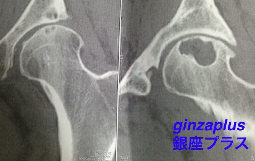 保存療法 ステロイド注射による副作用