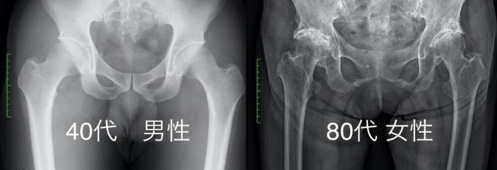 股関節痛 骨だけが痛みの原因ではない