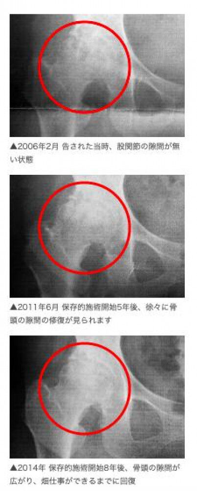 変形性股関節症 大阪へ行く理由