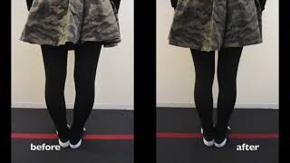 [施術事例] 大学生 股関節唇損傷