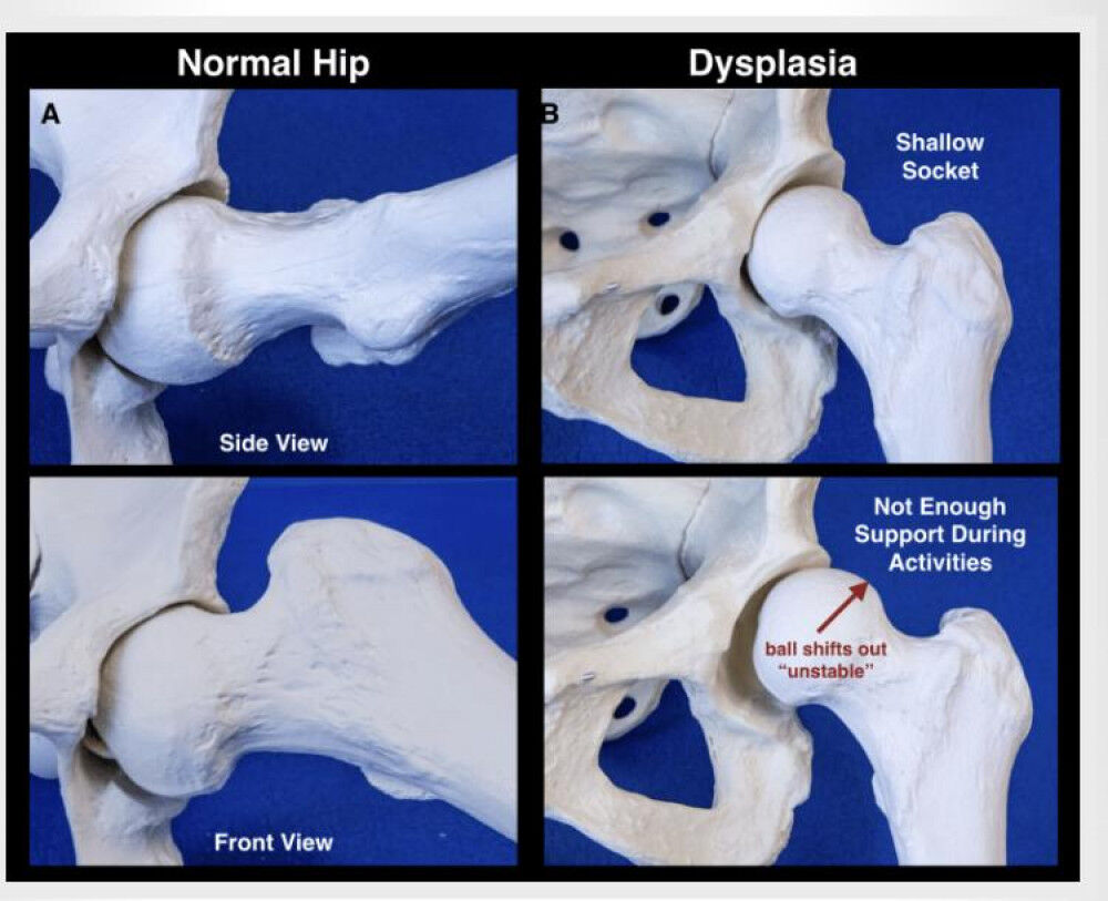 [股関節の基礎] Hip Instability(股関節の不安定性)