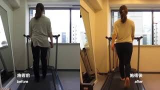 [施術事例] 40代 両側臼蓋形成不全