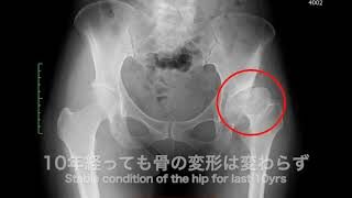 [施術事例] 50代 変形性股関節症 進行期/末期